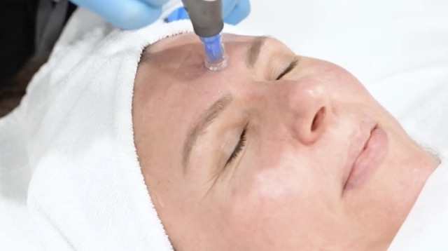 HydraFacial handpiece treatment